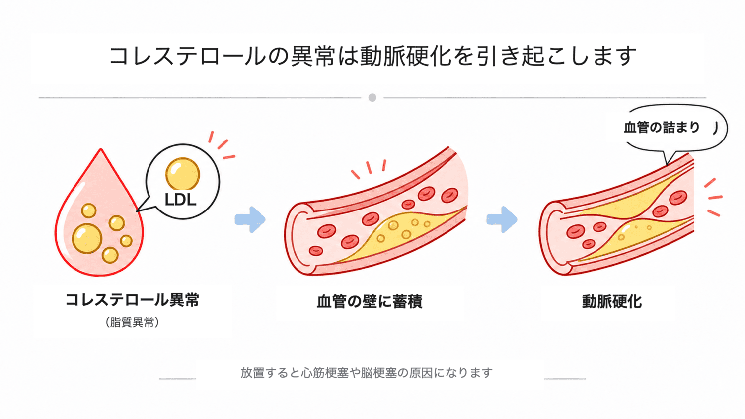 コレステロールの異常が動脈硬化を起こすまでのイメージイラスト