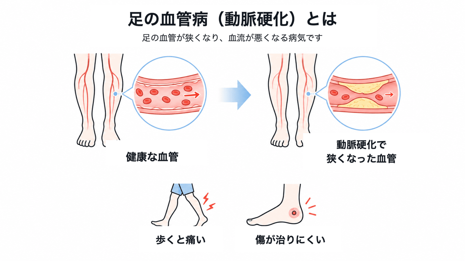足の血管病（動脈硬化）のイメージイラスト